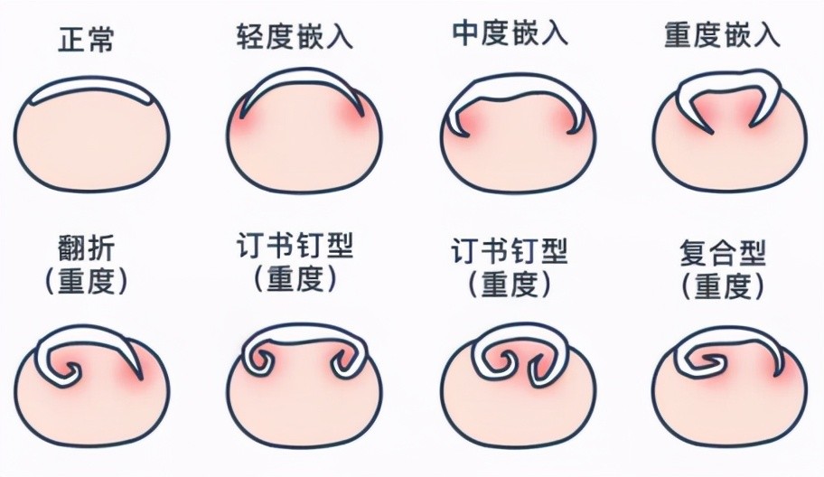 甲沟炎怎么治疗最快最好方法图片 _甲沟炎怎么治