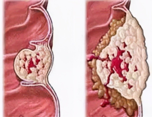 广药三院肿瘤一科:咽喉癌还是咽炎?这6点是关键
