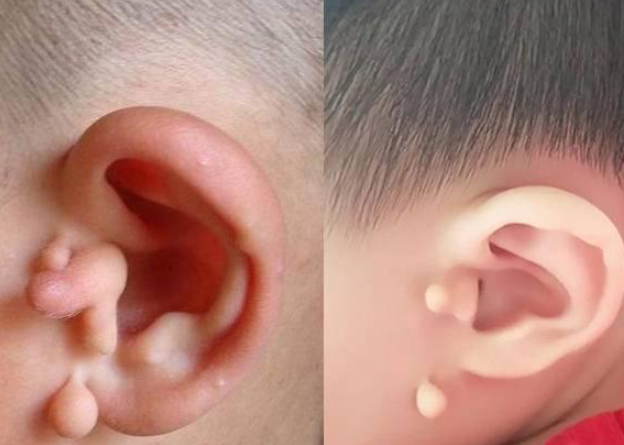 和"拴马桩"靠近的位置,宝宝还可能长着一"小孔",人们一般称之为"耳仓"