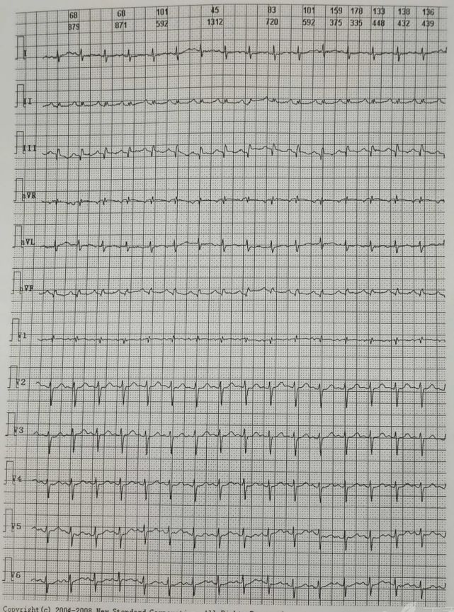 大量心包积液心电图达摩心电图专栏