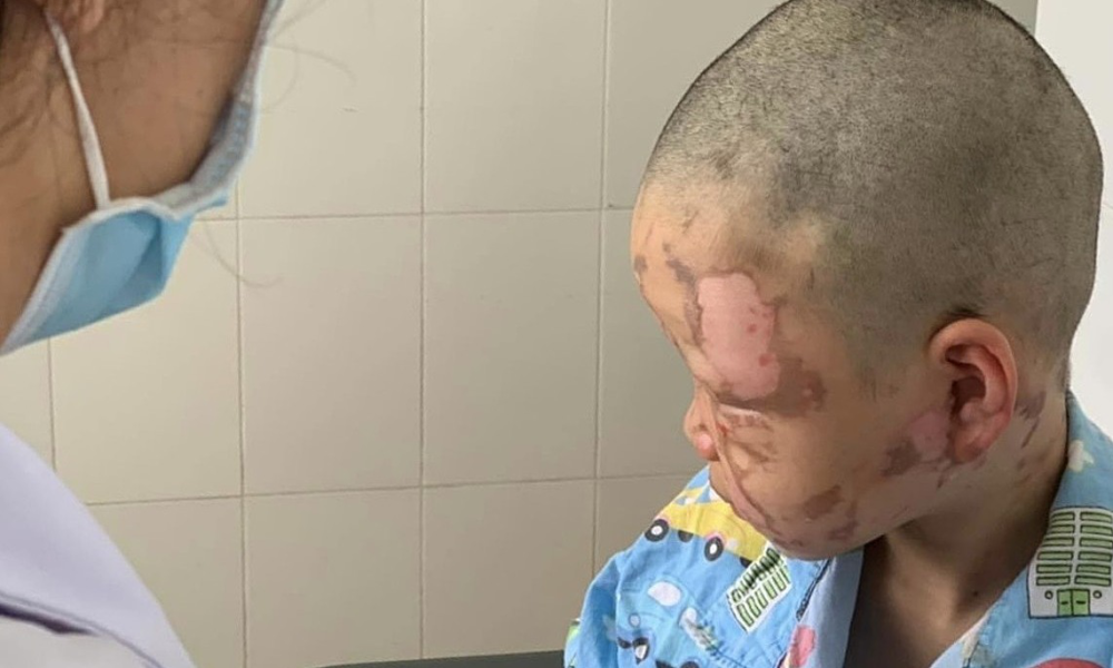 10岁男孩在家中玩酒精,意外将面部灼伤,现病情虽稳定却仍有疤痕