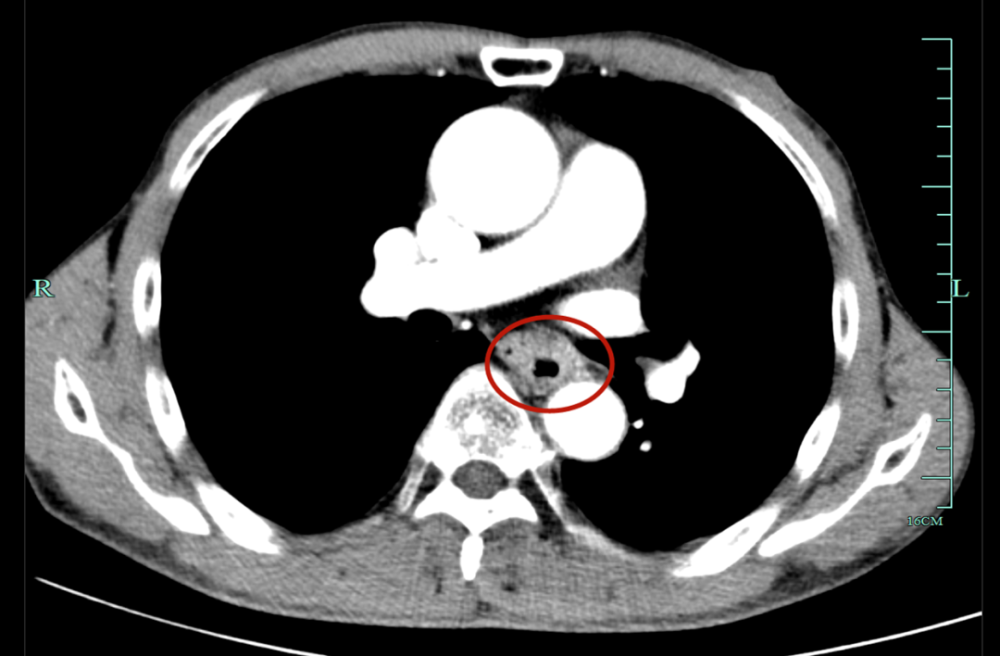 胃镜发现他的食管有占位伴有胆汁反流,随后的食道ct显示他食管中下段