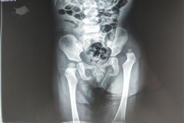 儿童骨盆x光图片