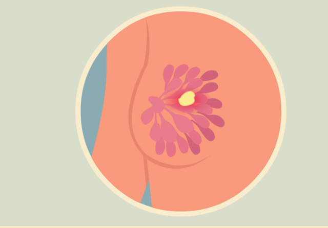 乳房有凸起医生判断是增生我掉以轻心结果2年后罹患乳腺癌