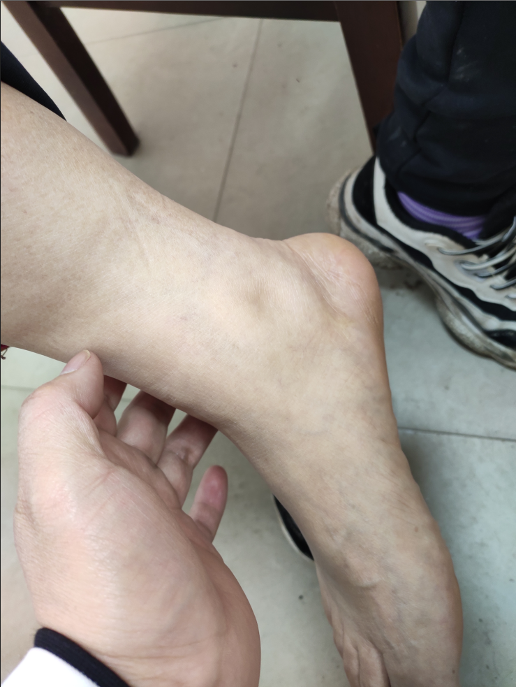 当液体在体内组织间隙呈弥漫性分布时呈全身性水肿常为凹陷性;液体