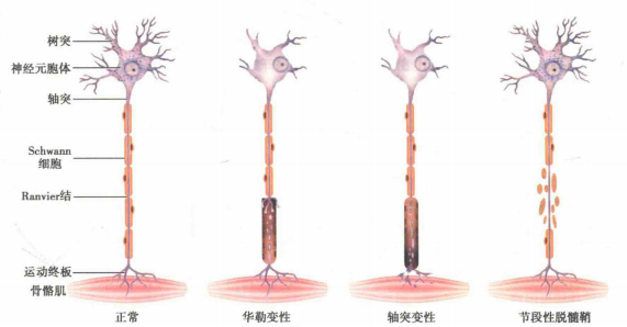 周圍神經疾病