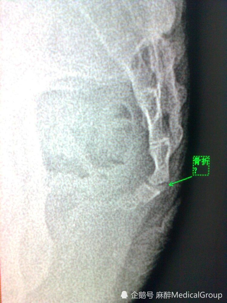 如果不是孩子片子上提示尾骨断裂谁也想不到父亲的这脚有多重