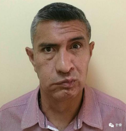 针刺一穴巧治病:面神经麻痹