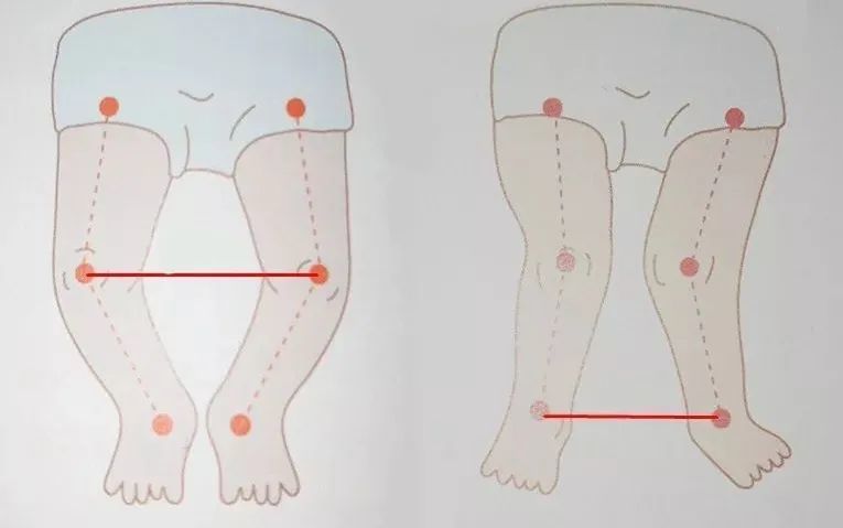 预防宝宝罗圈腿这些错误做法要不得