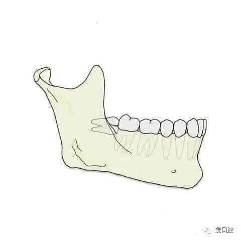 往期推薦口腔頜面部骨骼肌肉解剖圖譜關於下頜阻生牙暴力拔牙現象各類