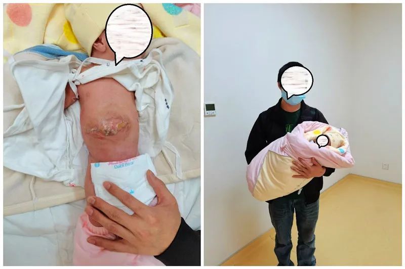 关关难过关关过妇幼"硬核技术"拯救新生"小型脐膨出手术治疗难度较小