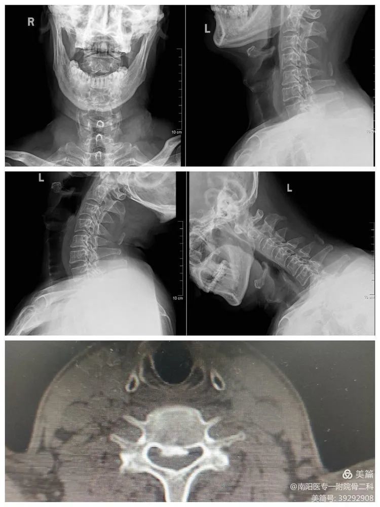 全麻下,經頸前路頸5/6椎間盤切除,植骨融合內固術,術後複查頸椎x光片