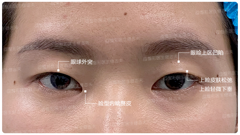 高度近视 眼凸 下垂 看这样的眼睛如何华丽变身 腾讯新闻