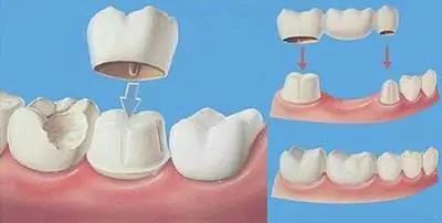 口腔健康牙齒缺失三種常見修復方式該選哪一種