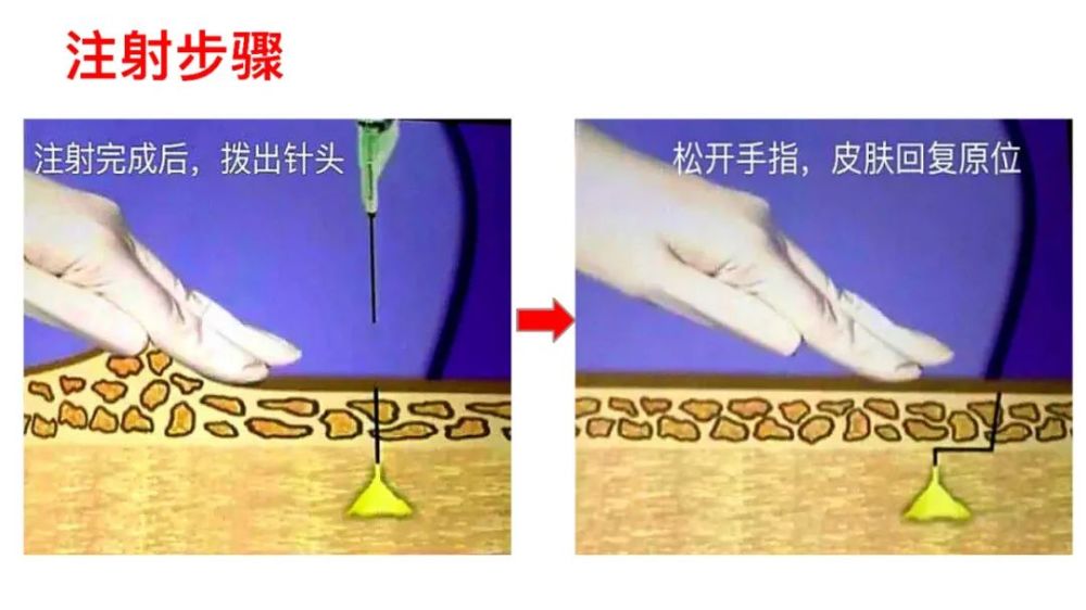 肌注硬結怎麼辦z型注射法瞭解一下