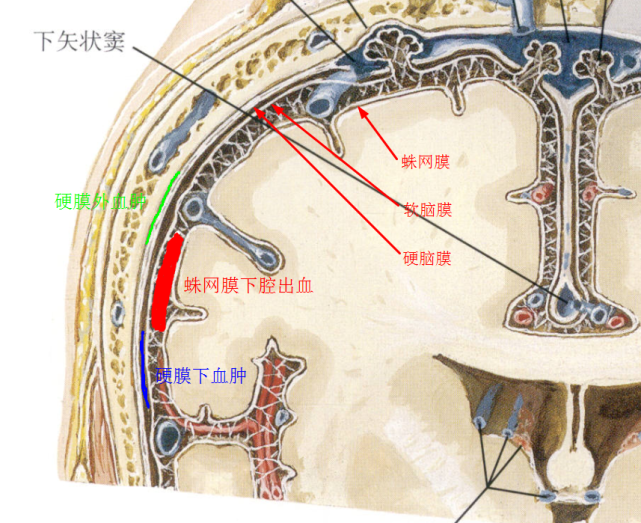 夜班不求人——颅骨骨折(上)|颅骨骨折|脑挫裂伤|颅骨|硬膜下血肿|脑