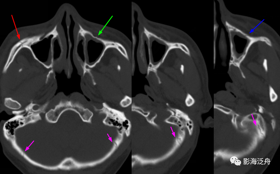 连续层面的第三层左侧上颌窦前壁又显示一透亮线影(蓝箭),这个是骨折