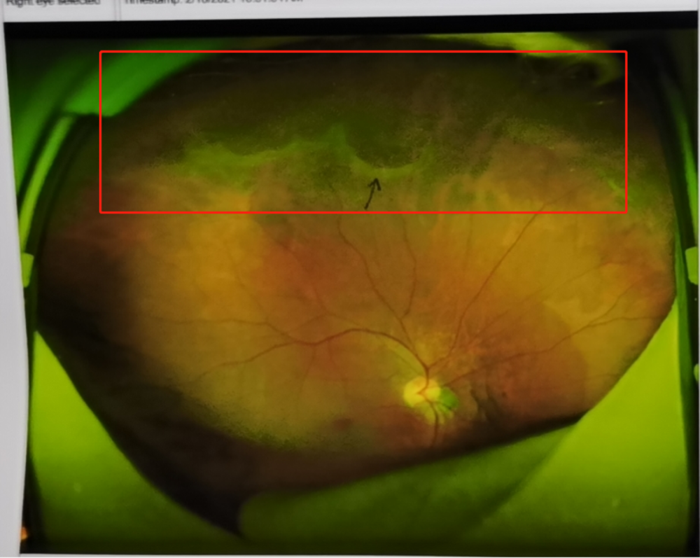 遗传几率不可小觑高度近视父亲视网膜裂孔两孩子查出同样病变