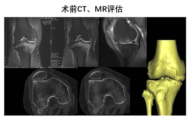 鲁东医院成功开展膝关节镜联合胫骨截骨术 腾讯新闻