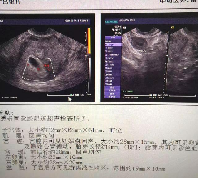 懷孕第一次做b超,陰超和腹部b超哪個好,有什麼區別_騰訊新聞