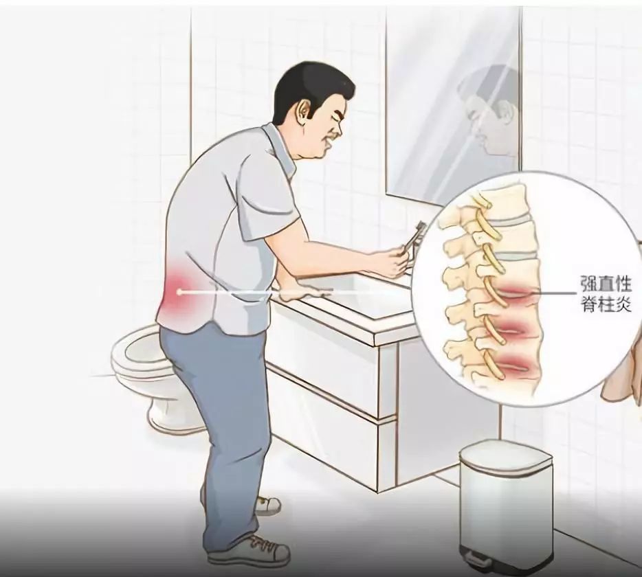 科普丨一文详细了解强直性脊柱炎,不可错过!_腾讯新闻