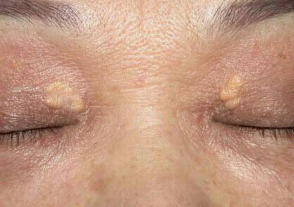 你的眼睑上有小黄瘤子吗?是不是血脂高的象征?营养师说出答案