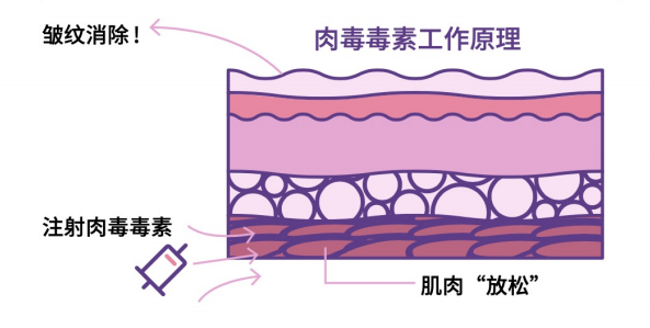 拒绝医美踩雷之肉毒毒素抗衰指南!