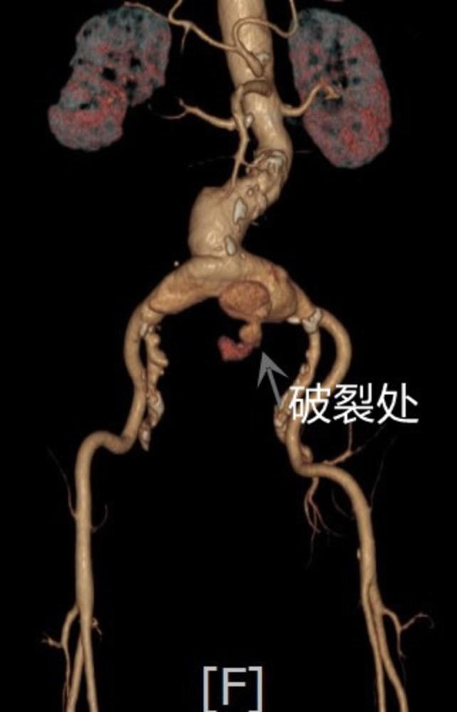 髂内动脉瘤图片