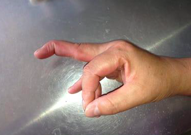 在骨科以往接诊的锤状指患者中,多数是因为运动损伤,比如打篮球戳伤最