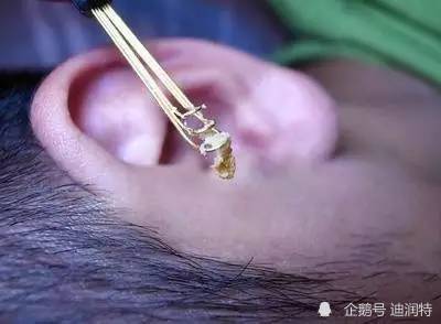 狐臭油耳朵是什么原因油耳朵与狐臭有什么关系