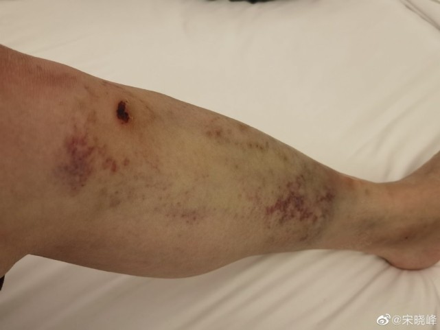 赵本山弟子宋晓峰拍戏好拼腿上淤青太吓人和秦霄贤同获冠军