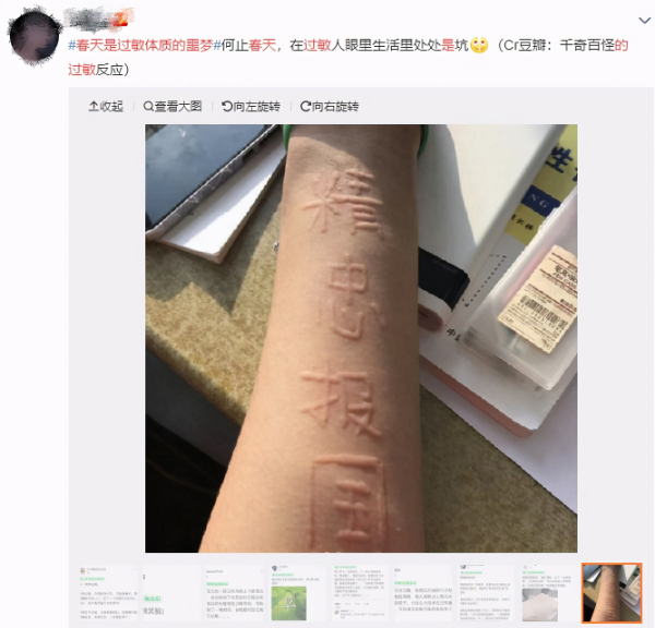 花粉,杨絮,柳絮等,都有可能引起很多朋友产生各种各样的过敏性问题