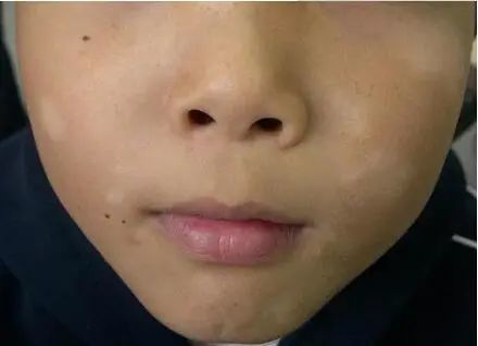 让青少年"痛苦不堪"的"桃花癣",究竟是何原因造成?_腾讯新闻