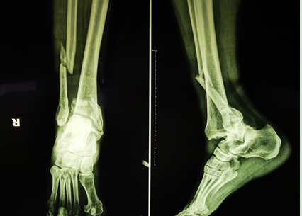 【青岛市胶州中心医院】老汉pilon骨折伴脱位 微创手术助其快速康复