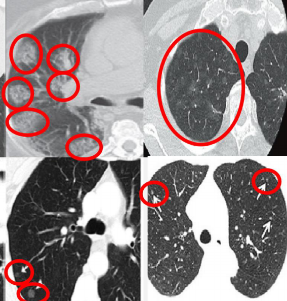 多发肺结节患者为什么越来越多?