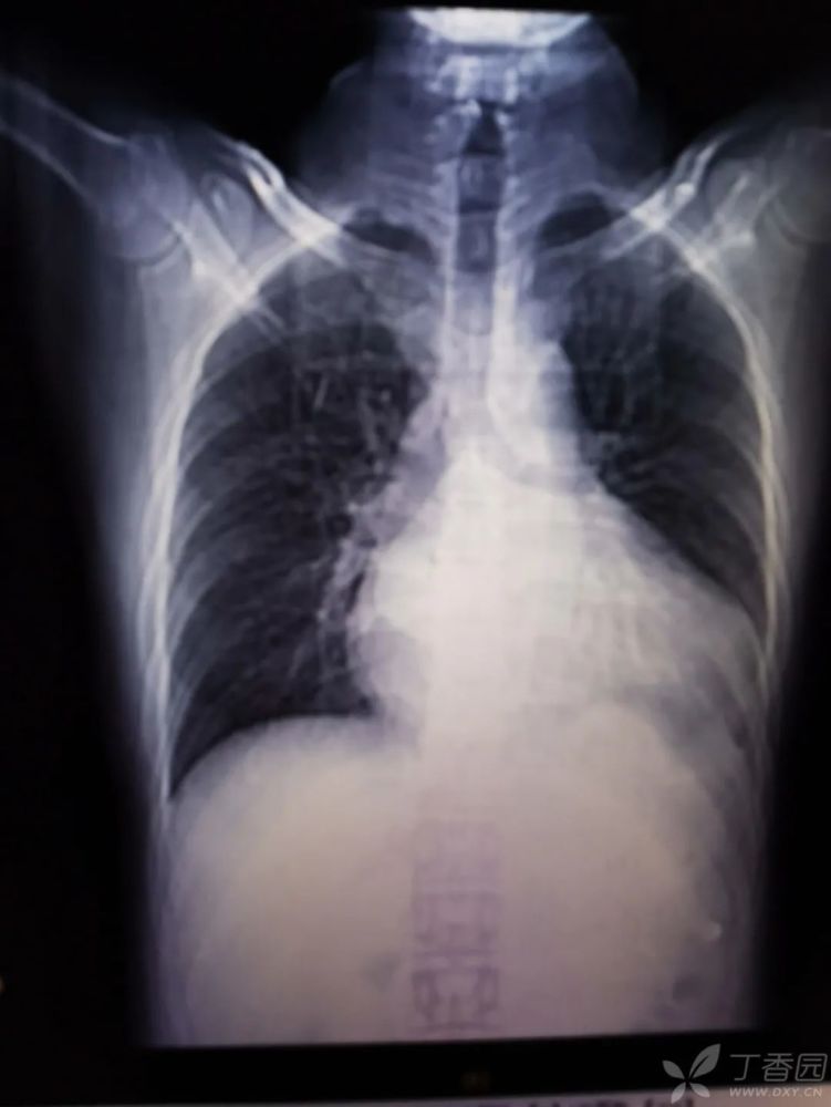 问:心脏功能为什么能在短时间内恢复正常?对此你有何见解?