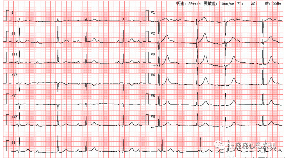趣味记忆心律失常心电图