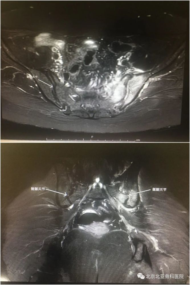 年紀輕輕卻腰臀部疼痛難忍原因竟是骶髂關節炎