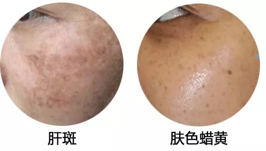 1-2个月也会重新长出新的"肝斑"用护肤品,即使暂时淡化掉一点中医又把