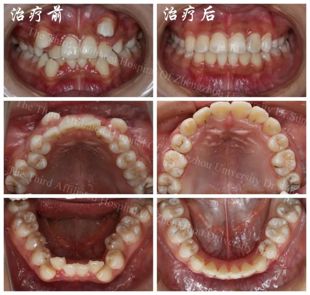 花季少女东倒西歪的牙