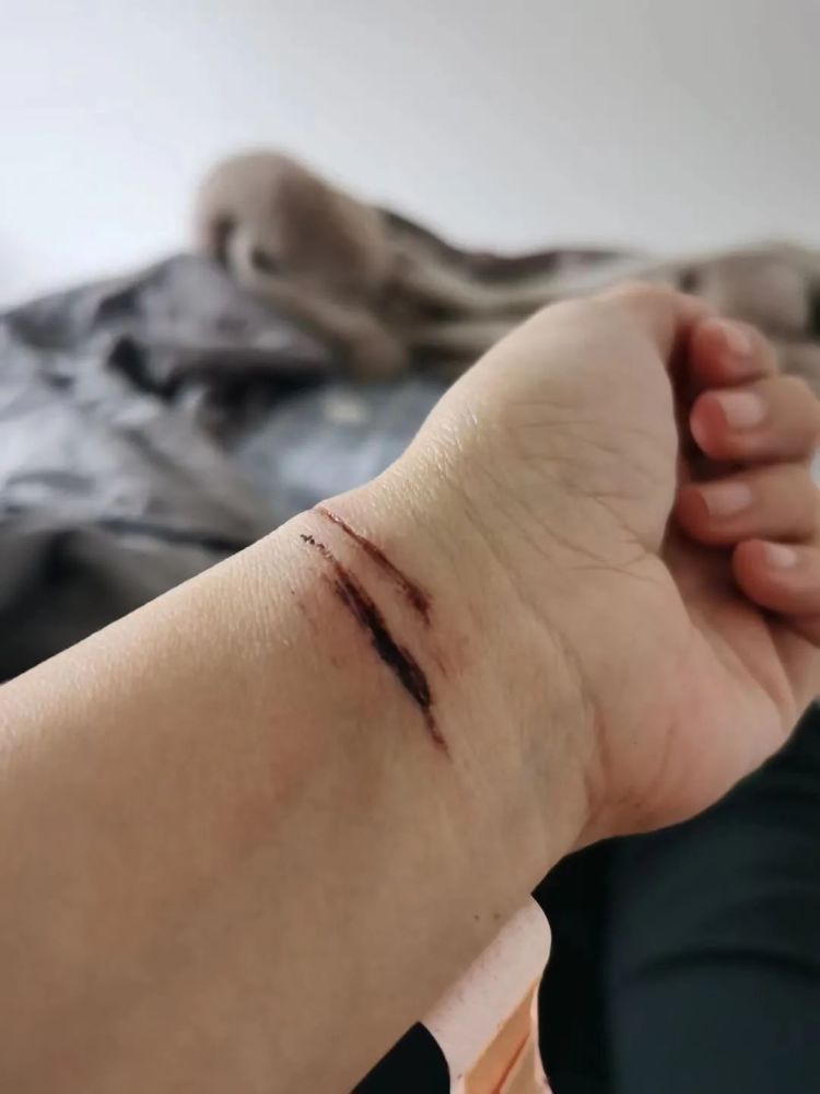 杨玉割腕留下刀痕的照片而且张勇也听说,杨玉为了让自己丈夫给自己