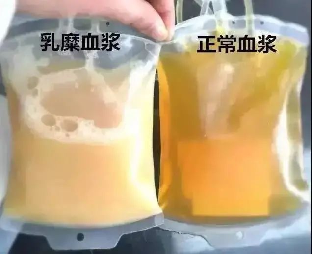 绍兴女子吃了顿夜宵抽出大袋牛奶血差点瘫痪