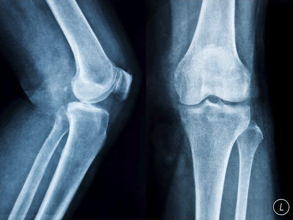 膝关节骨关节炎分四级不同时期不同治疗方法您都知道吗