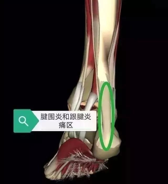 骨科小知識跟腱炎的診治小技巧