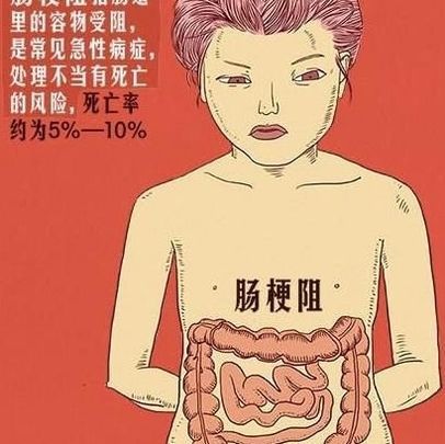 腸梗阻治療不及時會致命醫生提醒出現這些症狀請馬上就醫