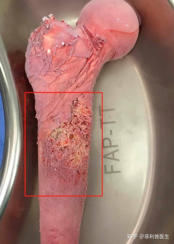 把骨头煮熟冷冻后再放回去这种方法治疗骨癌靠谱吗
