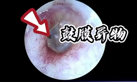 看看!耳窥镜下,被你"掏"的耳朵受伤有多深?