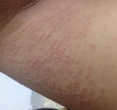 手上长鸡皮肤的湿疹(手上长鸡皮肤的湿疹怎么治)