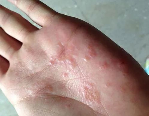 手上起湿疹怎么办(夏天手上起湿疹怎么办)
