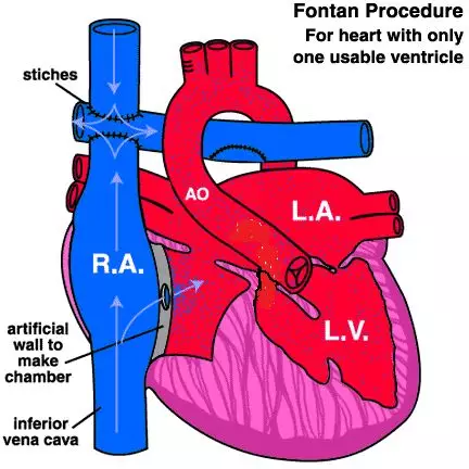 合肥京东方医院为复杂先心病患儿fontan手术再获成功